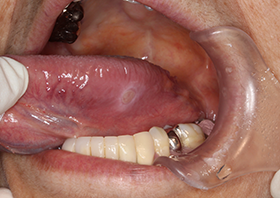 治し 口内炎 方 白い 口内炎の即効性のある治し方！10個の方法で確実に治そう！