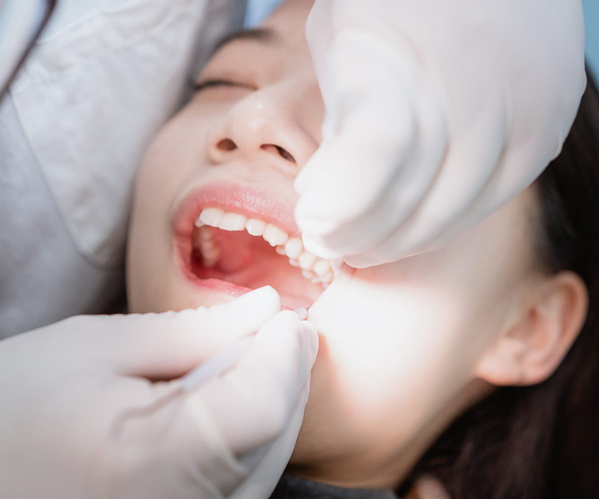迅速な抜歯治療 親知らずの状態により初診当日の抜歯も可能
